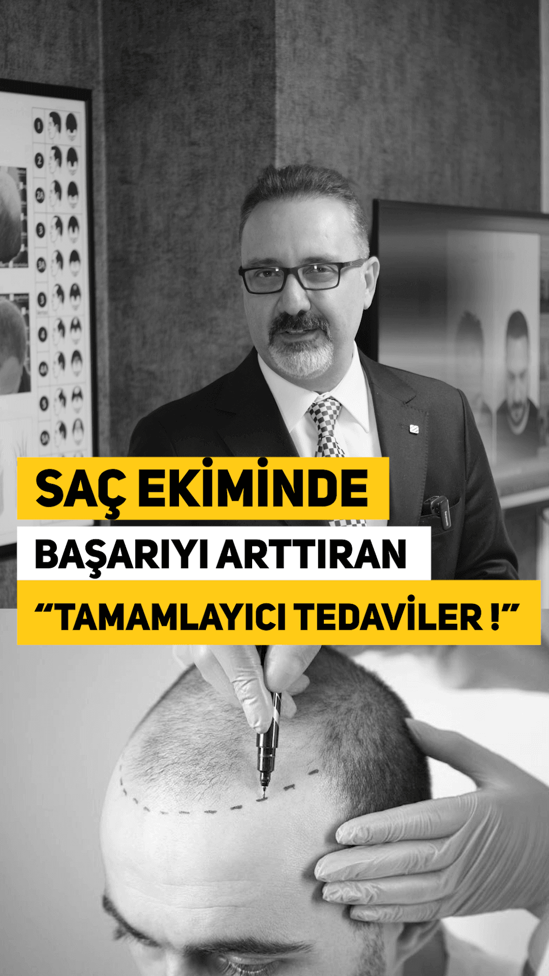 saç ekimi