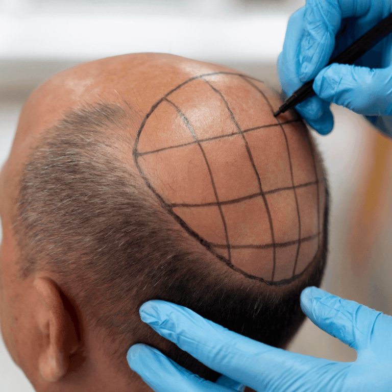 Ankara Fue Tekniği Saç Ekimi