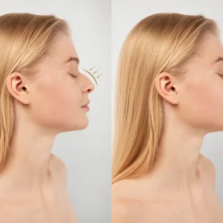 ankara burun dolgusu